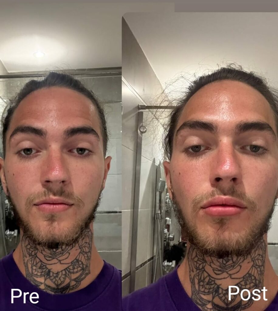 فيلر الشفايف للرجال